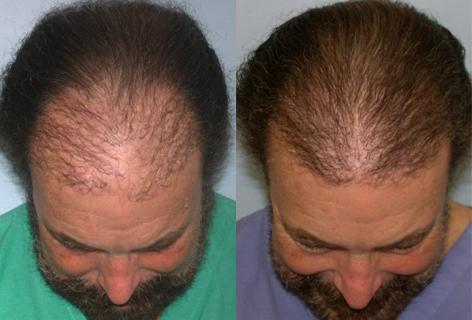 Follicular Unit Hair Grafting before and after photos in San Francisco, CA, Patient 13757