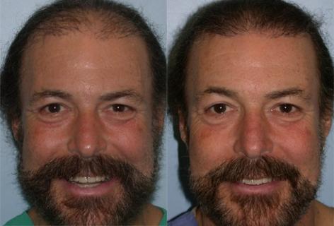 Follicular Unit Hair Grafting before and after photos in San Francisco, CA, Patient 13757