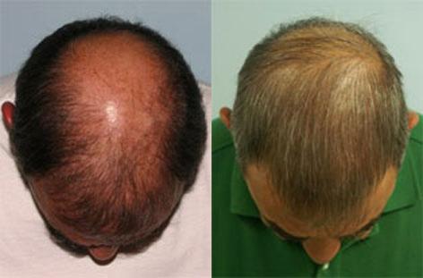 Follicular Unit Hair Grafting before and after photos in San Francisco, CA, Patient 13764