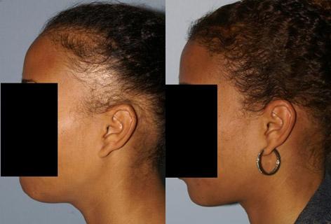 Follicular Unit Hair Grafting before and after photos in San Francisco, CA, Patient 13769