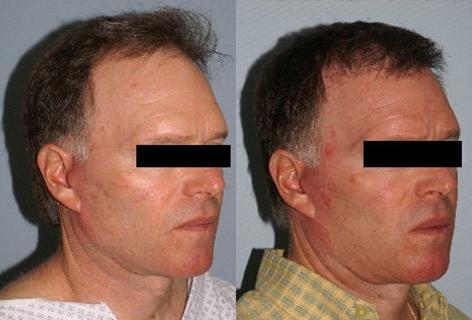 Follicular Unit Hair Grafting before and after photos in San Francisco, CA, Patient 13772