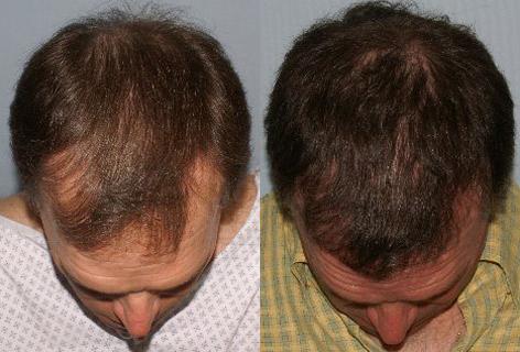 Follicular Unit Hair Grafting before and after photos in San Francisco, CA, Patient 13772