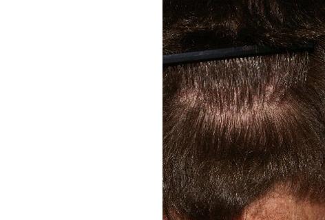 Follicular Unit Hair Grafting before and after photos in San Francisco, CA, Patient 13772