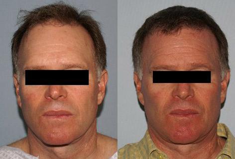 Follicular Unit Hair Grafting before and after photos in San Francisco, CA, Patient 13772