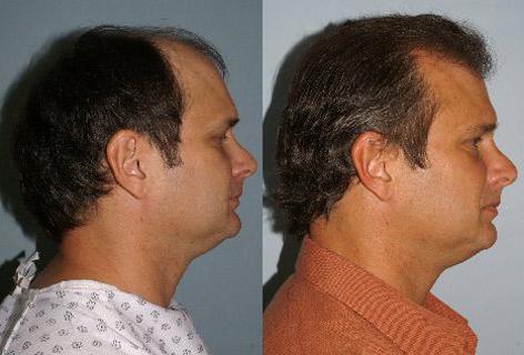 Follicular Unit Hair Grafting before and after photos in San Francisco, CA, Patient 13781