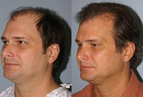 Follicular Unit Hair Grafting before and after photos in San Francisco, CA, Patient 13781