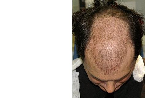 Follicular Unit Hair Grafting before and after photos in San Francisco, CA, Patient 13781