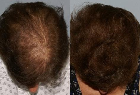 Follicular Unit Hair Grafting before and after photos in San Francisco, CA, Patient 13795