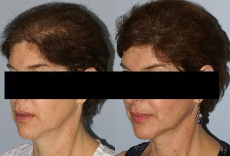 Follicular Unit Hair Grafting before and after photos in San Francisco, CA, Patient 13795