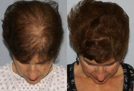 Follicular Unit Hair Grafting before and after photos in San Francisco, CA, Patient 13795