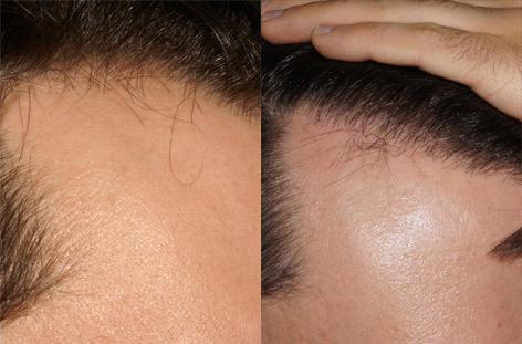 Follicular Unit Hair Grafting before and after photos in San Francisco, CA, Patient 13809