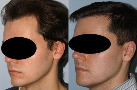 Patient 13809, Follicular Unit Hair Grafting before and after photos Follicular Unit Hair Grafting before and after photos in San Francisco, CA, Patient 13809