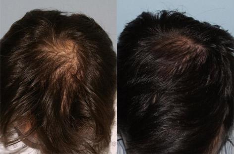 Follicular Unit Hair Grafting before and after photos in San Francisco, CA, Patient 13809