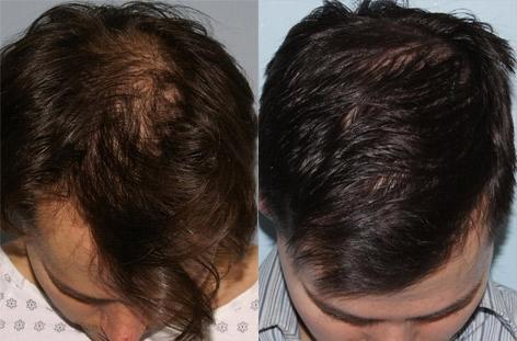 Follicular Unit Hair Grafting before and after photos in San Francisco, CA, Patient 13809