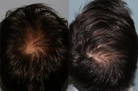 Follicular Unit Hair Grafting before and after photos in San Francisco, CA, Patient 13809