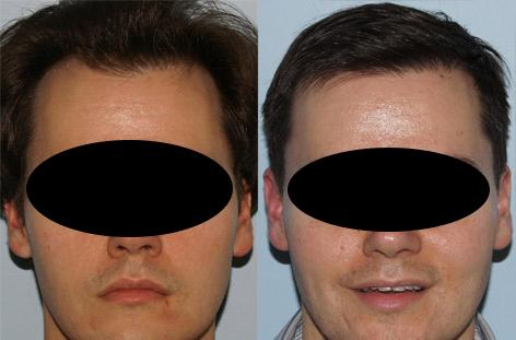 Follicular Unit Hair Grafting before and after photos in San Francisco, CA, Patient 13809