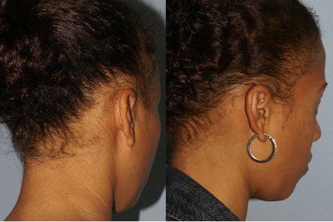 Follicular Unit Hair Grafting before and after photos in San Francisco, CA, Patient 13820