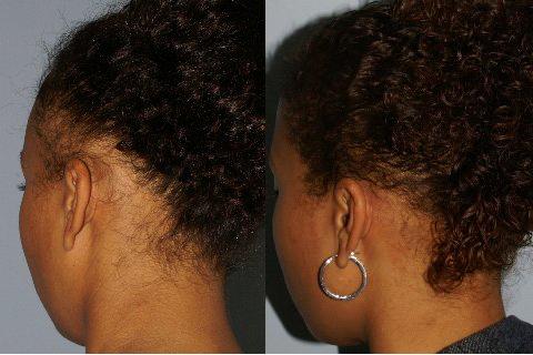 Follicular Unit Hair Grafting before and after photos in San Francisco, CA, Patient 13820