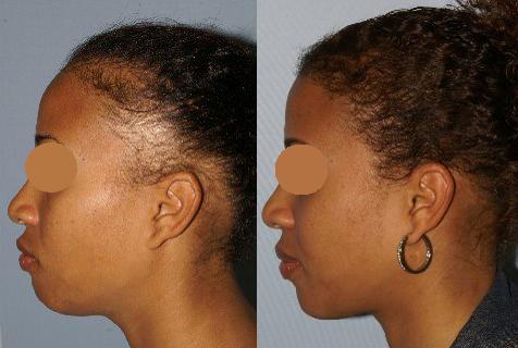 Follicular Unit Hair Grafting before and after photos in San Francisco, CA, Patient 13820