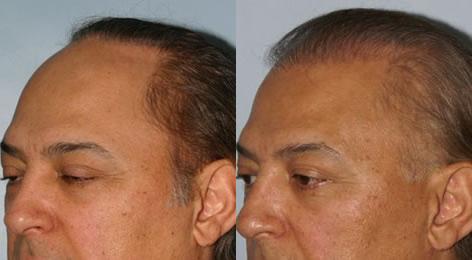 Repair of prior hair plug cases before and after photos in San Francisco, CA, Patient 13885