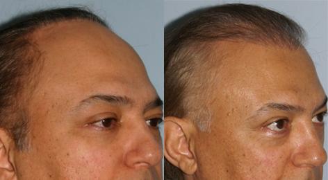 Repair of prior hair plug cases before and after photos in San Francisco, CA, Patient 13885