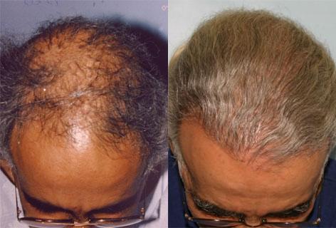 Repair of prior hair plug cases before and after photos in San Francisco, CA, Patient 13892