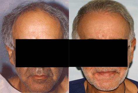 Repair of prior hair plug cases before and after photos in San Francisco, CA, Patient 13892
