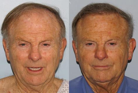 Patient 13897, Repair of prior hair plug cases before and after photos Repair of prior hair plug cases before and after photos in San Francisco, CA, Patient 13897