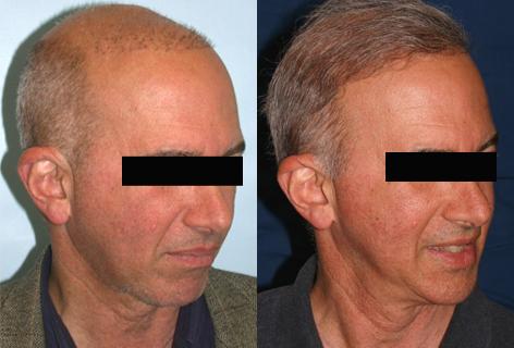 Repair of prior hair plug cases before and after photos in San Francisco, CA, Patient 13902