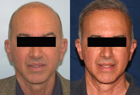 Repair of prior hair plug cases before and after photos in San Francisco, CA, Patient 13902