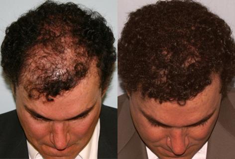 Repair of prior hair plug cases before and after photos in San Francisco, CA, Patient 13907