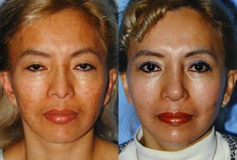 Chemical Resurfacing before and after photos in San Francisco, CA, Patient 14355