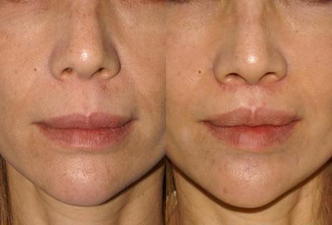 Sub Nasal Lip Lift before and after photos in San Francisco, CA, Patient 14358