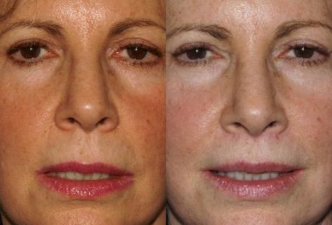 Sub Nasal Lip Lift before and after photos in San Francisco, CA, Patient 14363