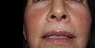 Sub Nasal Lip Lift before and after photos in San Francisco, CA, Patient 14363