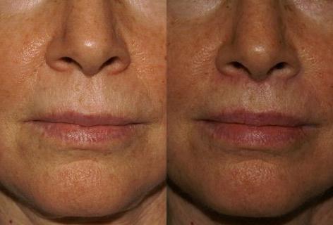 Sub Nasal Lip Lift before and after photos in San Francisco, CA, Patient 14363