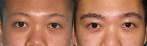 Hair Eyebrow Transplant before and after photos in San Francisco, CA, Patient 14370