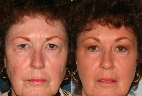 Blepharoplasty before and after photos in San Francisco, CA, Patient 12945