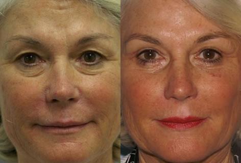 Blepharoplasty before and after photos in San Francisco, CA, Patient 12951