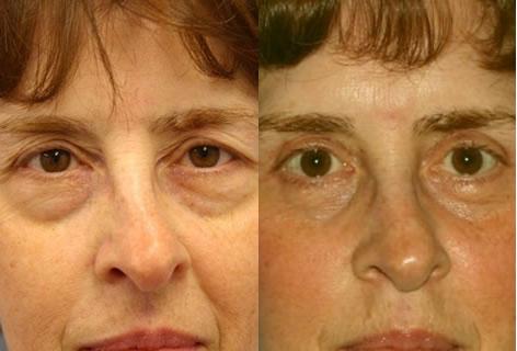 Blepharoplasty before and after photos in San Francisco, CA, Patient 12954