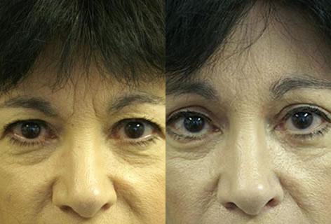 Blepharoplasty before and after photos in San Francisco, CA, Patient 12957