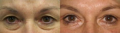 Blepharoplasty before and after photos in San Francisco, CA, Patient 12960