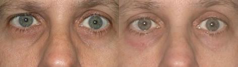 Blepharoplasty before and after photos in San Francisco, CA, Patient 12963