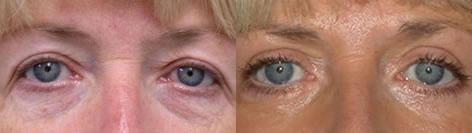 Blepharoplasty before and after photos in San Francisco, CA, Patient 12966