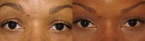 Blepharoplasty before and after photos in San Francisco, CA, Patient 12969