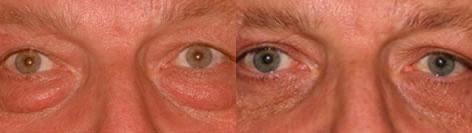 Blepharoplasty before and after photos in San Francisco, CA, Patient 12975
