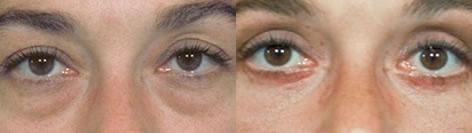Blepharoplasty before and after photos in San Francisco, CA, Patient 12978