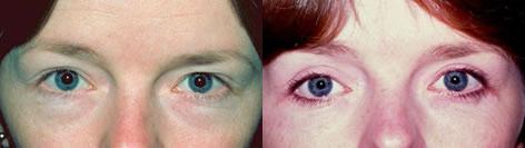 Blepharoplasty before and after photos in San Francisco, CA, Patient 12981