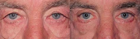 Blepharoplasty before and after photos in San Francisco, CA, Patient 12984