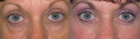 Blepharoplasty before and after photos in San Francisco, CA, Patient 12987